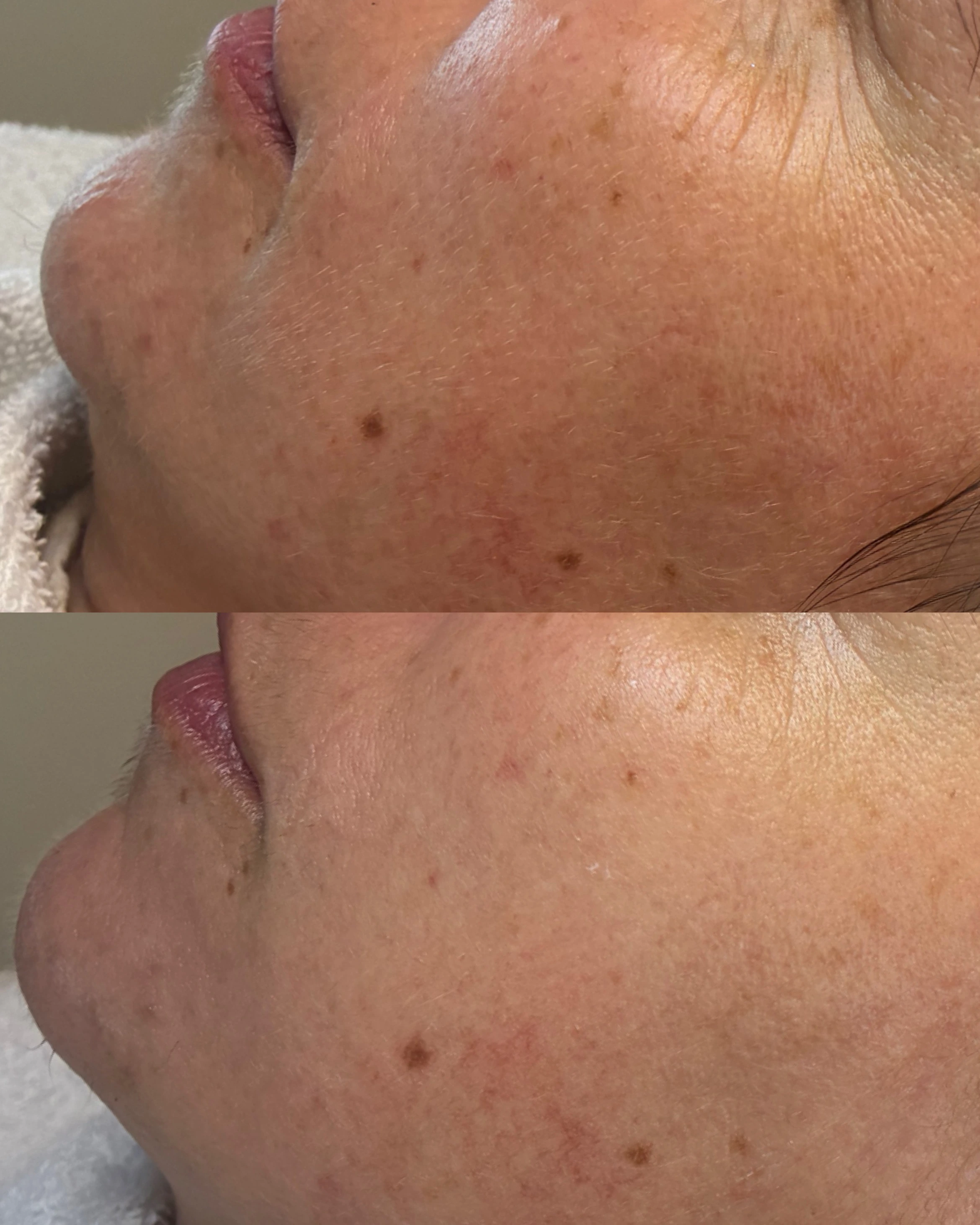 Chemický peeling